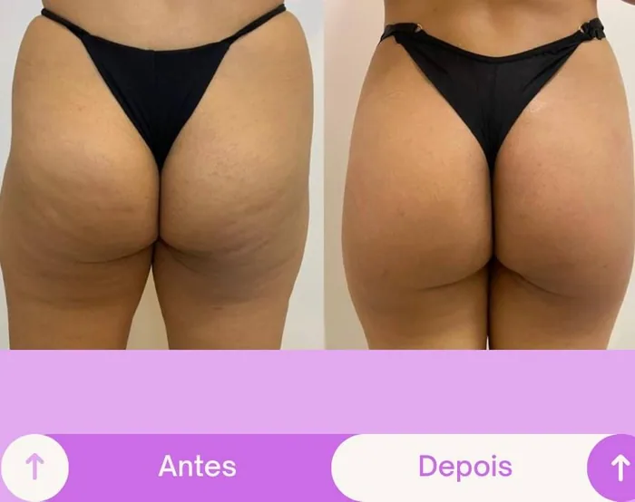 Antes e depois, contorno do glúteo