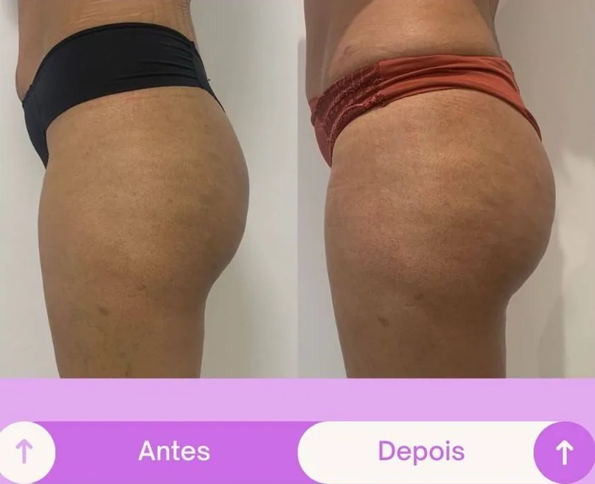 Antes e depois 1
